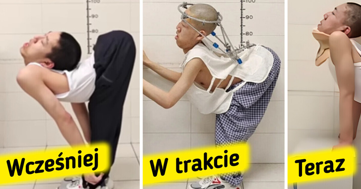 Nastolatek zwany „złożonym chłopcem” przeszedł ryzykowną operację i jest o krok bliżej wyprostowanej postawy