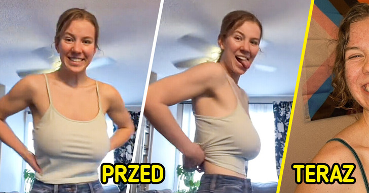 Kobieta dokumentuje operację zmniejszenia piersi i pokazuje szokujące rezultaty