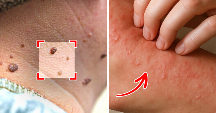 6 ukrytych objawów cukrzycy, które mogą ci umknąć