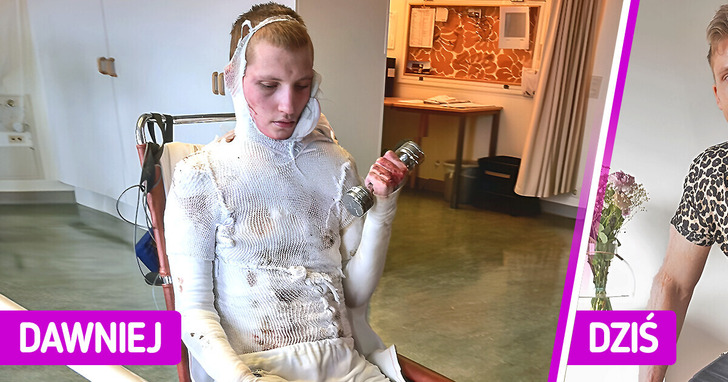 Piosenkarz, który wskutek porażenia prądem doznał rozległego poparzenia ciała, zaakceptował swój wygląd