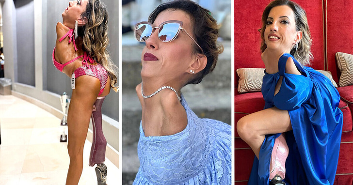 Kobieta z bardzo rzadkim schorzeniem przełamuje stereotypy i staje się źródłem nadziei dla wielu