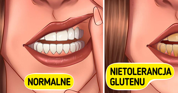 11 mniej znanych objawów nietolerancji glutenu