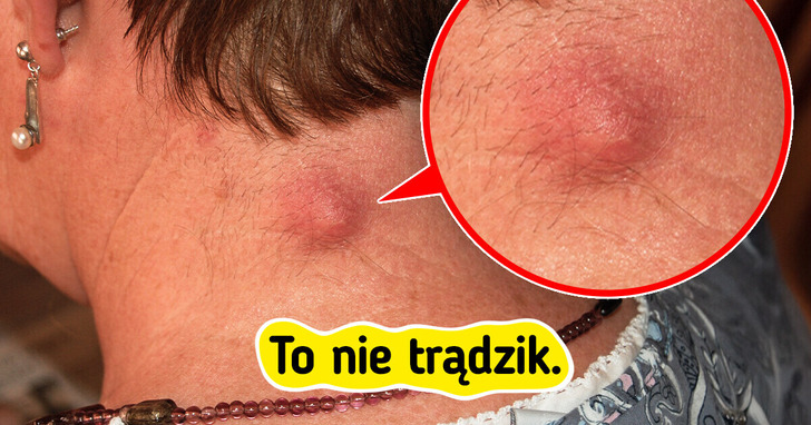 7 zmian skórnych innych niż trądzik, które warto znać