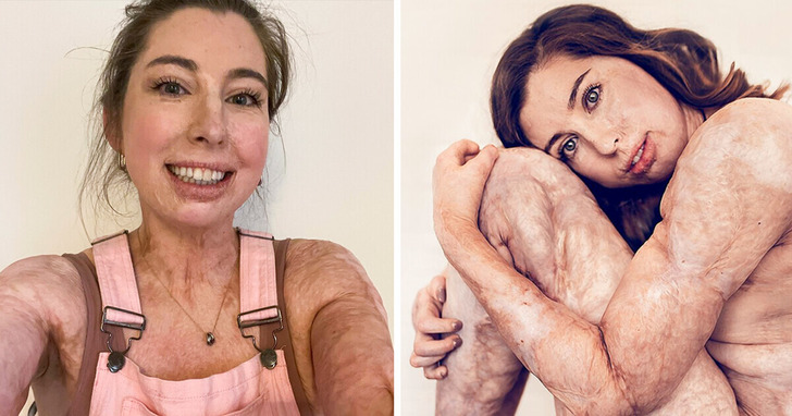 Historia kobiety, która przeżyła poparzenia 96% powierzchni ciała i wstrząsnęła branżą kosmetyczną