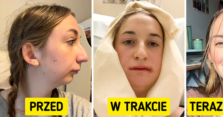 Młoda kobieta ujawnia piorunujące efekty operacji szczęki, wprawiając ludzi w osłupienie