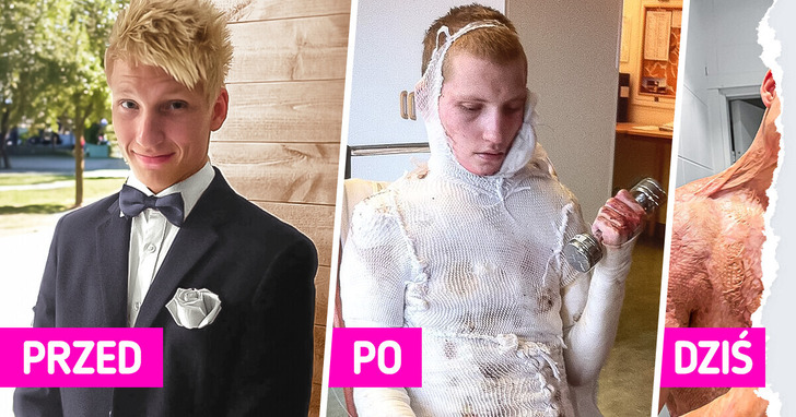 „Winię siebie” — piosenkarz akceptuje swój nowy wygląd po tym, jak doznał rozległego poparzenia wskutek porażenia prądem