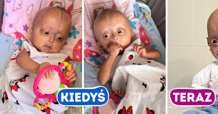 Poznajcie bliźnięta z rzadką „chorobą Benjamina Buttona”