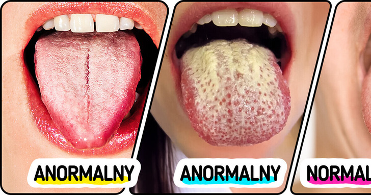 8 skutecznych sposobów na odzyskanie zdrowego, różowego języka