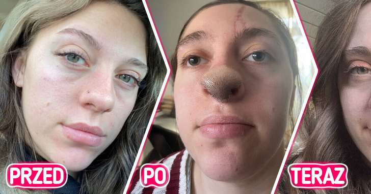 Pogryzienie przez psa spowodowało, iż ta młoda kobieta ma zarośnięty nos