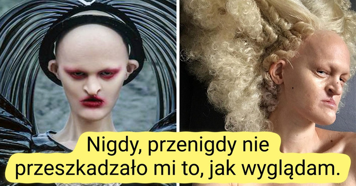 Poznajcie Melanie Gaydos — modelkę z rzadką chorobą genetyczną, która przełamuje stereotypy dotyczące urody