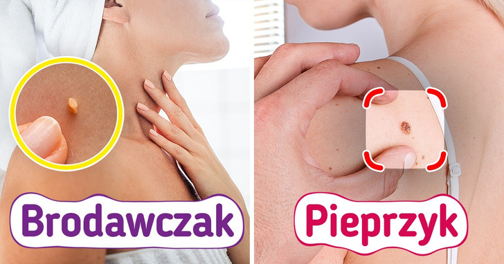 Skąd biorą się znamiona i dlaczego tak ważne jest, by umieć je rozróżnić