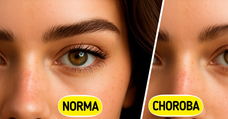 10 ukrytych znaków, iż masz kłopoty z tarczycą