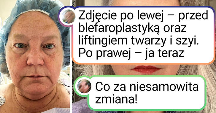 18 kobiet, które zdecydowały się na zabiegi upiększające i całkowicie zmieniły swój wygląd