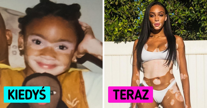 Poznajcie Winnie Harlow, supermodelkę z bielactwem, która od dzieciństwa walczy ze stereotypami dotyczącymi urody