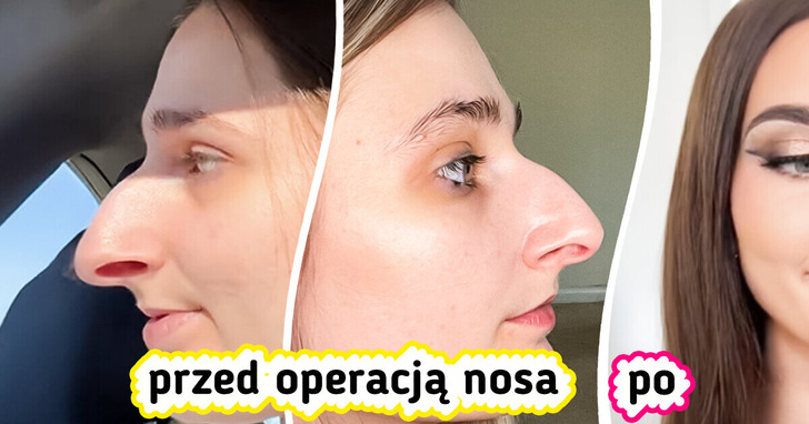 Kobieta oszczędzała przez dekadę na operację nosa — efekty dzielą internet