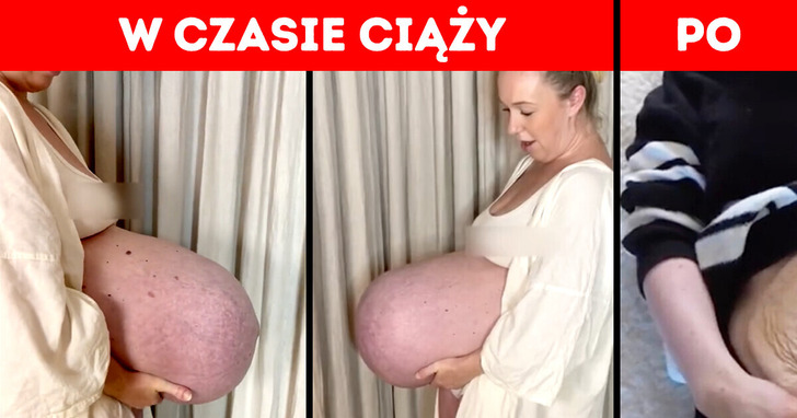 Gigantyczny brzuch ciążowy, który „wyskakuje na zewnątrz”. Jak to jest możliwe?!
