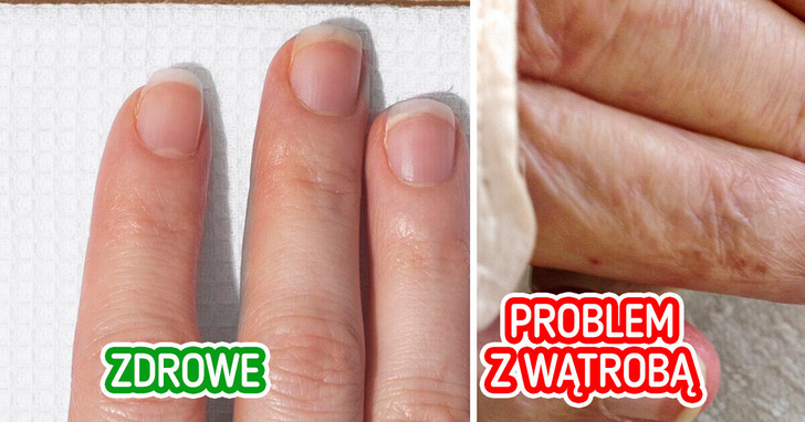 6 nietypowych objawów, które mogą świadczyć o problemach z wątrobą