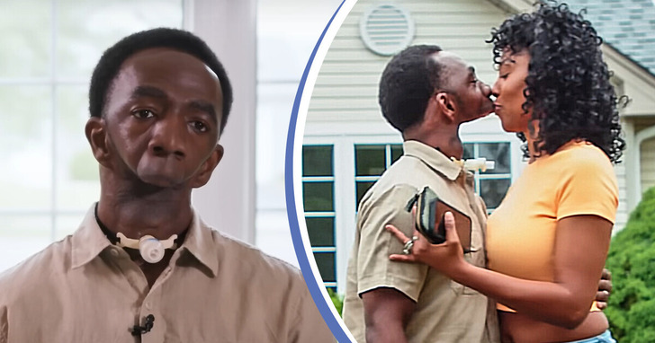 „Ona nie może go pocałować!” Mężczyzna bez szczęki znalazł prawdziwą miłość, ale jego związek wywołał lawinę komentarzy