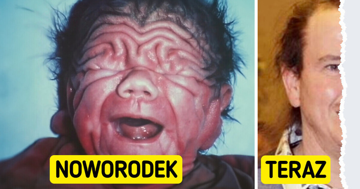 Historia chłopca, który urodził się z rzadką chorobą i pokonał przeciwności losu