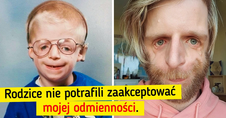 Dziecko porzucone ze względu na swój wygląd dziś jest 37-letnim modelem i mówcą motywacyjnym