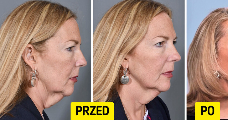 „Wygląda 20 lat młodziej” — kobieta poddała się operacji, która całkowicie ją odmieniła, a ludzie zaniemówili z wrażenia