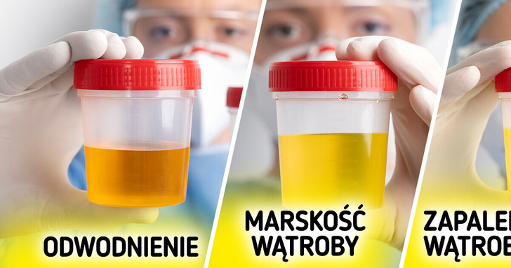 7 nietypowych kolorów moczu, których nie należy ignorować