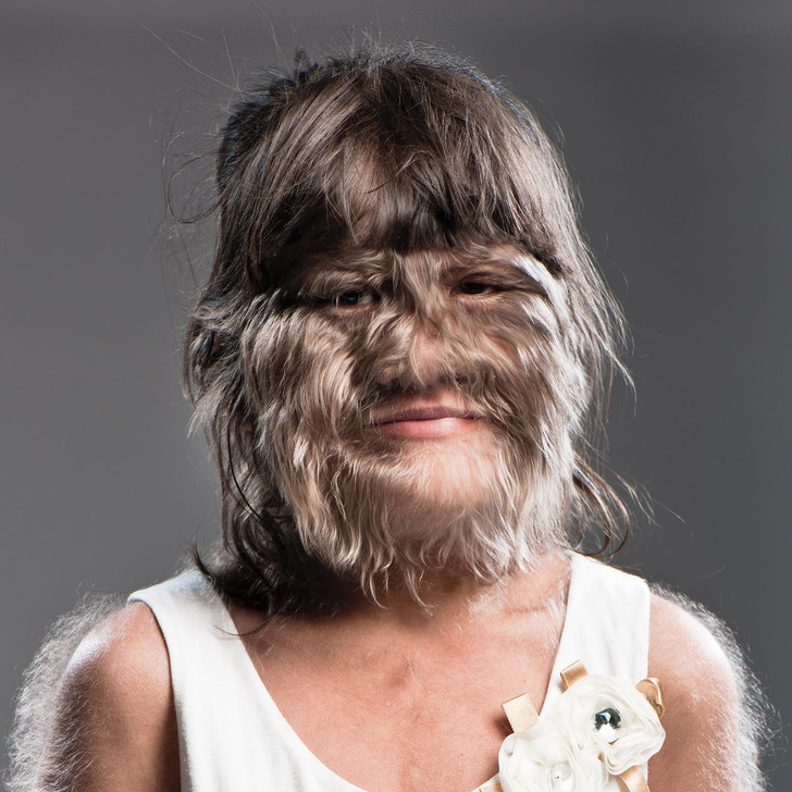 A young girl with fur-like facial hair all over her face and arms, smiles in white dress.