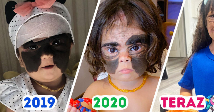 Dziewczynka ze znamieniem jak „maska Batmana” dorosła i jej mama ma wspaniałe wiadomości