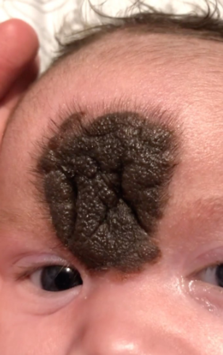 A close-up of a brown and furry birthmark between the eyes of a kid.